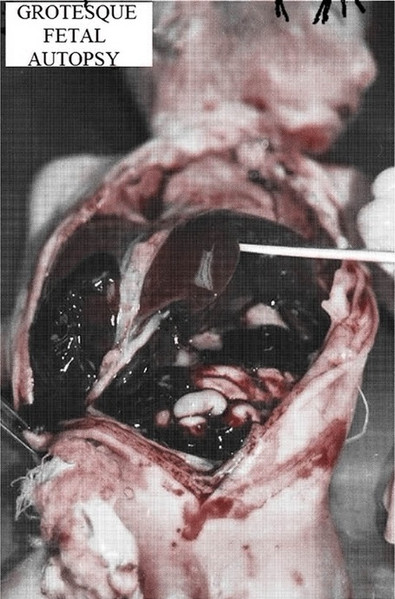 Grotesque Fetal Autopsy