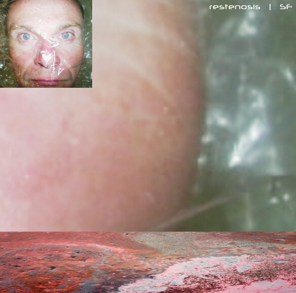 Restenosis