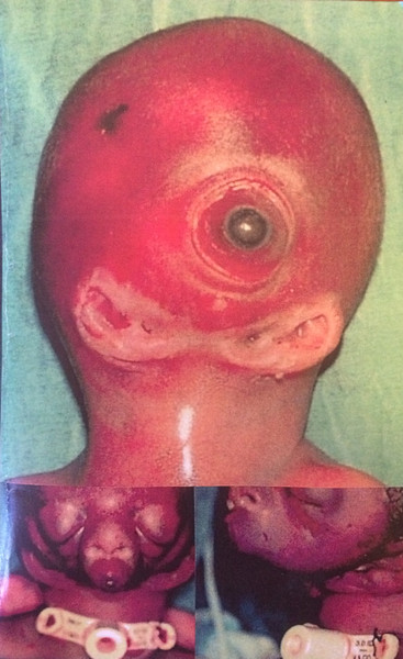 Otocephaly