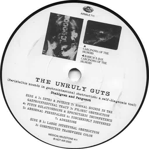 The Unruly Guts (Peristaltic Sounds In Gastrointestinal Obstruction: A Self Diagnosis Tool)