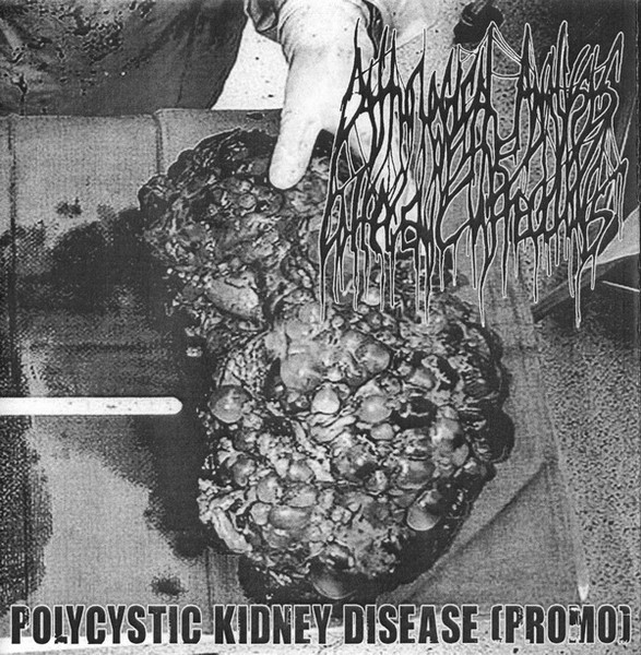 Polycystic Kidney Disease