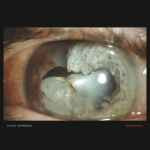 Anaesthesia