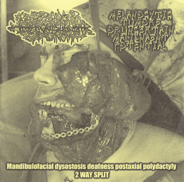 Mandibulofacial Dysostosis Deafness Postaxial Polydactyly 2 WAY SPLIT