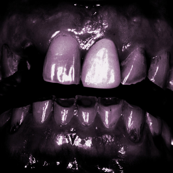 Grinding Teeth 