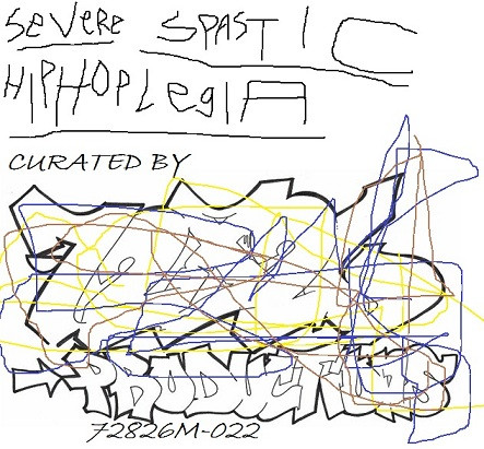 Severe Spastic Hiphoplegia