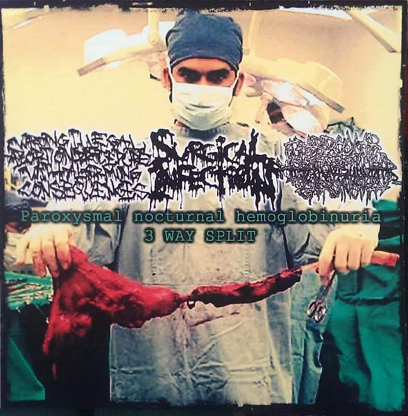 Paroxysmal Nocturnal Hemoglobinuria 3 Way Split