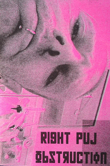 Right P.U.J Obstruction